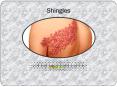 Shingles: Symptoms, Risk factors, Causes, Diagnosis and Treatment PowerPoint PPT Presentation