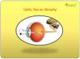 Optic Nerve Atrophy: A guide to symptoms, causes and treatment PowerPoint PPT Presentation