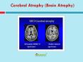 Cerebral Atrophy (Brain Atrophy): Learn about symptoms, causes and treatment PowerPoint PPT Presentation