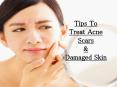 Tips To Treat Acne Scars & Damaged Skin PowerPoint PPT Presentation
