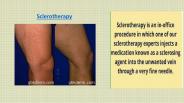 Sclerotherapy Cost