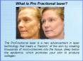 Information About the Profractional Laser to Remove Scars PowerPoint PPT Presentation
