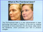 Information About the Profractional Laser to Remove Scars