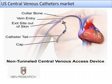 US Central Venous Catheters market