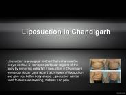 Cosmetic Surgery in Chandigarh (1)