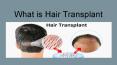 Get Complete Hair Transplant Procedure PowerPoint PPT Presentation