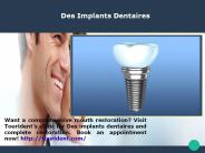 Implant Dentaire Complet