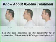 Information About the Kybella Injections