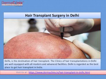 Best Procedures of Hair Transplantation