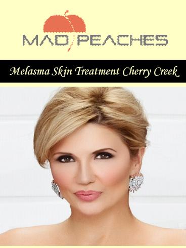 Melasma Skin Treatment Cherry Creek