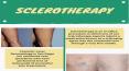 Best Sclerotherapy At Sclerotherapysandiego PowerPoint PPT Presentation