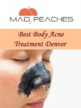Best Body Acne Treatment Denver PowerPoint PPT Presentation