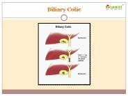 Biliary Colic