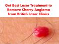 Get Best Laser Treatment to Remove Cherry Angioma from British Laser Clinics PowerPoint PPT Presentation