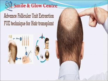Hair Transplant In Nawanshahr, Best Hair Transplant Clinic In Nawanshahr