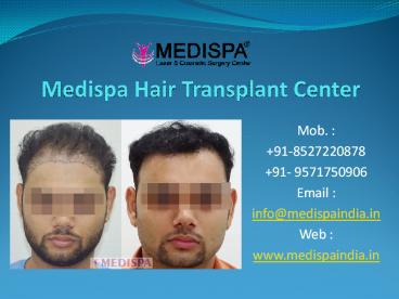 Best Hair Translant Clinic In Jaipur