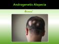Androgenetic Alopecia Causes, Symptoms, Diagnosis, Risk factor, Prevention Treatment in India PowerPoint PPT Presentation