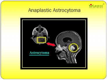 Anaplastic Astrocytoma : Causes, Symptoms, Diagnosis, Risk factor, Prevention Treatment in India