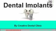 Dental Implants