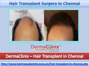 Hair Transplant Surgery in Delhi