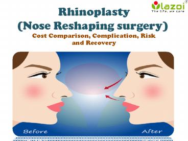 Rhinoplasty (Nose Reshaping surgery) - Cost Comparison, Complication, Risk and Recovery