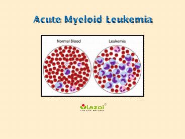 Acute Myeloid Leukemia Causes, Symptoms, Diagnosis, Prevention Treatment in India