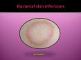 Bacterial skin infections : Causes, Symptoms, Treatment and Diagnosis PowerPoint PPT Presentation