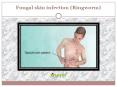 Fungal skin infection (Ringworm): Causes, Symptoms, Risk Factor, Diagnosis and Treatment (1) PowerPoint PPT Presentation
