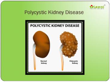 Polycystic kidney disease : Causes, Symptoms, Diagnosis, Complication and Treatment (1)