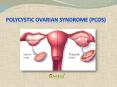 Polycystic ovarian syndrome (PCOS) : Causes, Symptoms, Diagnosis, Complication and Treatment (1) PowerPoint PPT Presentation