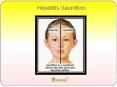 Hepatitis (Jaundice) : Overview, causes, symptoms, sign, diagnosis and treatmemt (1) PowerPoint PPT Presentation