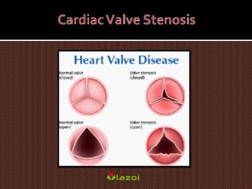 cardiac valve stenosis : Symptoms, Types, Causes, Treatment and Diagnosis (1)