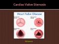 cardiac valve stenosis : Symptoms, Types, Causes, Treatment and Diagnosis (1) PowerPoint PPT Presentation
