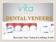 Dental Veneers Treatment- Complete Guide PowerPoint PPT Presentation
