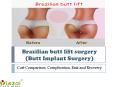 Brazilian butt lift surgery (Butt Implant Surgery) - Cost Comparison, Complication, Risk and Recovery PowerPoint PPT Presentation