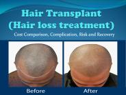 Complete guide for Hair Transplant (Hairloss Treatment)