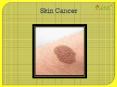 Skin Cancer : Overview, Symptoms, Causes, Sign, Risk Factor, Complication, Diagnosis and Treatment (1) PowerPoint PPT Presentation