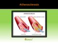 Atherosclerosis : Causes, symptoms, diagnosis and treatment PowerPoint PPT Presentation
