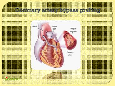 Coronary artery bypass grafting