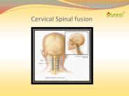 Cervical Spinal fusion