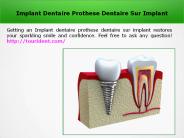 Dentist Implants
