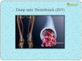 Deep vein Thrombosis (DVT) (1) PowerPoint PPT Presentation