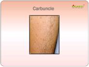 Carbuncle: Causes, Symptoms, Diagnosis, Treatment and Prevention (1)