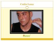 Cutis Laxa: Causes, Symptoms, Diagnosis and Treatment (1)