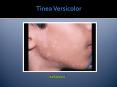 Tinea Versicolor: Symptoms, Causes, Diagnosis and Treatment (2) PowerPoint PPT Presentation