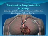 A guide to Pacemaker Implantation Surgery