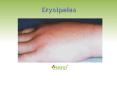 Erysipelas: Symptoms, Causes, Diagnosis and Treatment (1) PowerPoint PPT Presentation