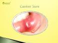 Canker Sore: Causes, Symptoms, Diagnosis and Treatment (1) PowerPoint PPT Presentation