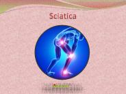 Sciatica: Causes, Symptoms, Diagnosis and Treatment (1)