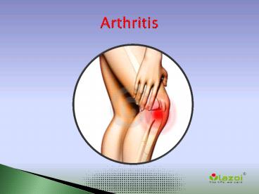 Arthritis: Symptoms, causes, diagnosis, treatment and prevention (1)